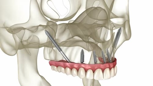 Maxillary and Mandibular prosthesis supported by zygomatic implants