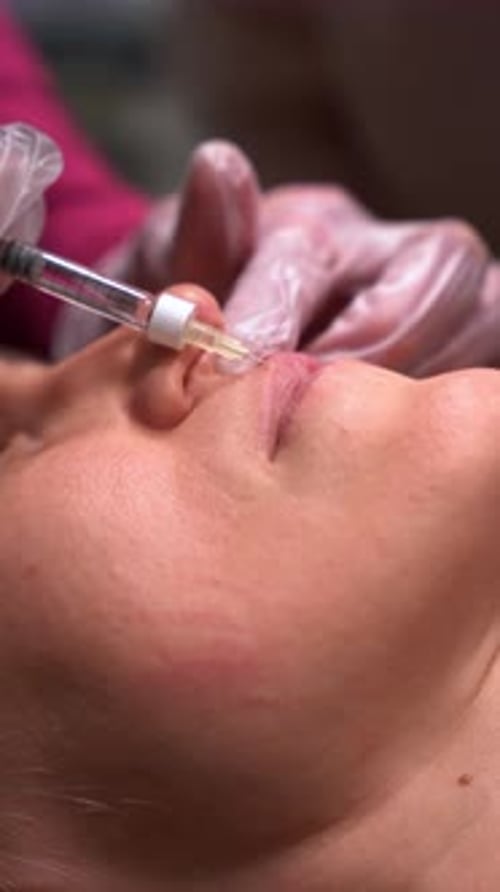 Cosmetic Procedure Injection of Lip Filler in Clinic