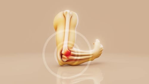 3D Medical Animation of Inflamed Human Elbow Joint