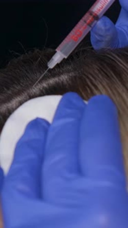 A Closeup of a Cosmetic Injection Into a Patient's Head Vertical Video