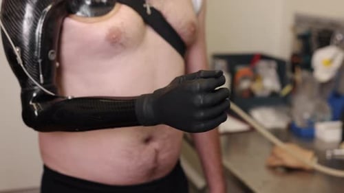 Adult Man with High-Tech Bionic Arm Prosthesis