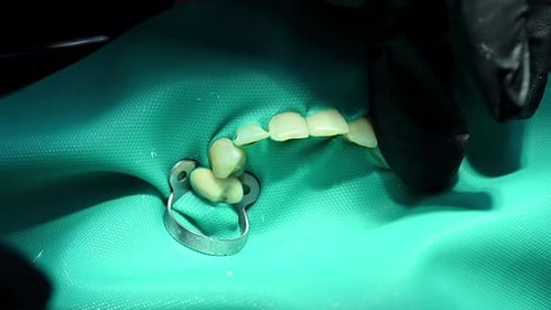 Dental Extreme Close Up Macro Video Dentist Treat Patient Teeth Orthodontist Works with an Assistant