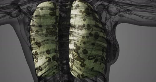 3D Medical Animation of Diseased Human Lungs