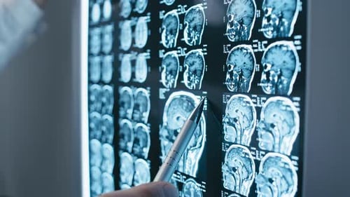 Doctor Examines Brain Scan with Pen Close Up