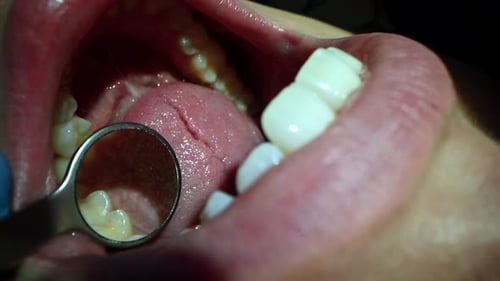 Dental Care Extreme Close Up Macro Video Dentist Treat Patient Teeth Orthodontist Works with