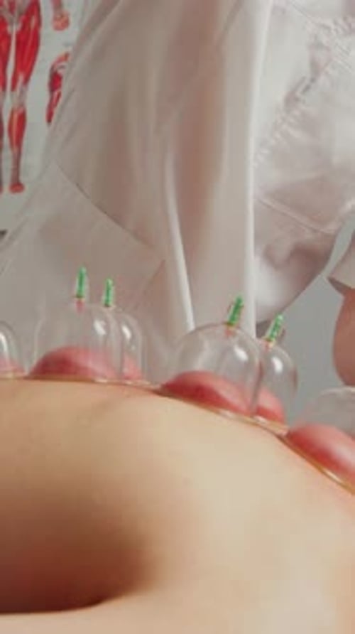 Cupping Therapy Treatment in Clinical Setting
