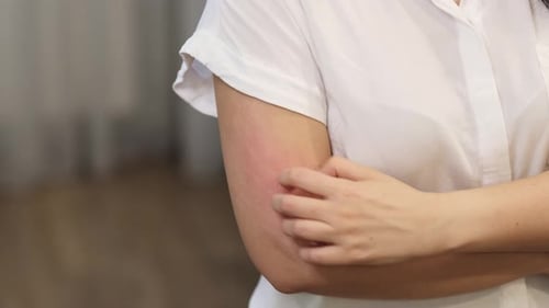 Junge kaukasische Frau leidet an rotem Hautausschlag und Juckreiz am Arm, verursacht durch eine Allergie, die zu