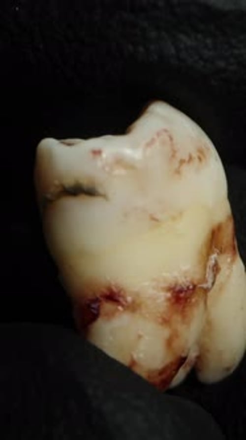 Vertical video. Close-up of a Hand in a Black Glove Examining a Bloodied Human Tooth.