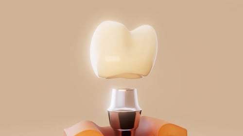Animated 3D Dental Implant Placement with Bone Cross-Section