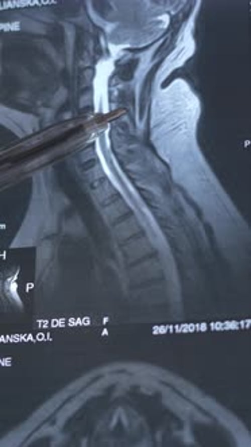 MRI Scan of Neck Showing Spine and Health