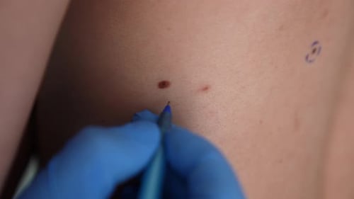 Arzt untersucht markierten Maulwurf am männlichen Torso