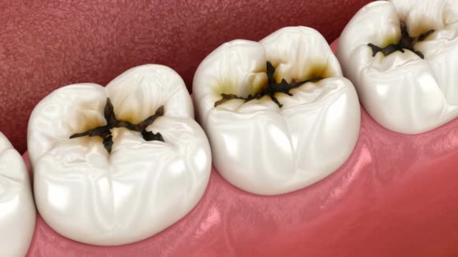 Molar teeth damaged by caries. Medically accurate tooth 3D animation ...