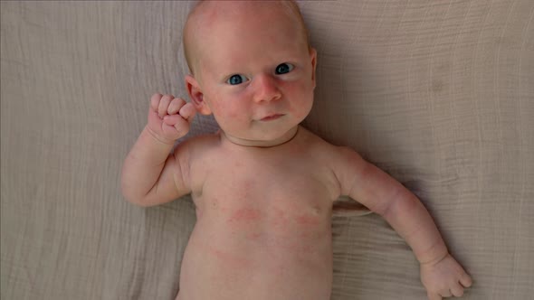 A Newborn Baby with Visible Rashes on His Body Highlighting a Common ...