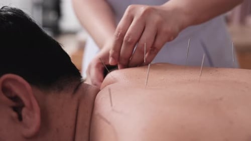 Nahaufnahme eines Akupunkturverfahrens zur Linderung von Rückenschmerzen.