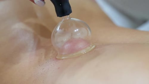 Masseur applying the suction cup treatment (cupping) on the patient's back to relieve pain and activ