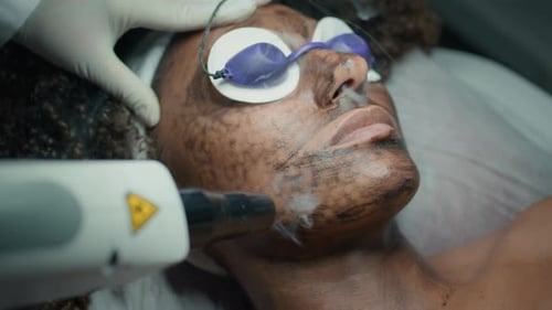 Woman Receiving Carbon Peel Laser Facial Treatment