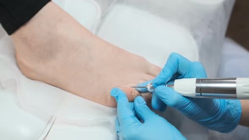 Medical Foot Care Procedure Close-Up