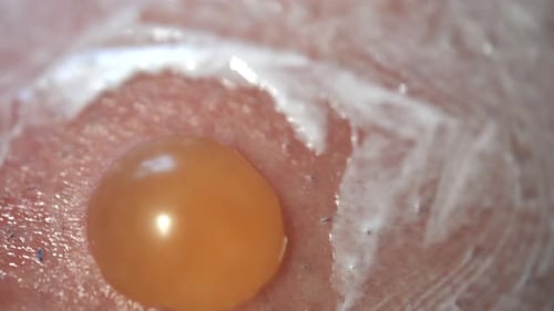 Extreme Close-Up of Pustule on Skin