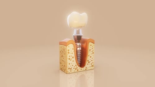 Animated 3D Dental Implant Installation in Jawbone
