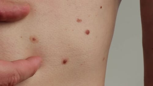 Unrecognizable Man Showing His Birthmarks on Skin Close Up Detail of the Bare Skin Sun Exposure