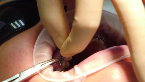 El ortodoncista instala aparatos ortopédicos de ligadura con arco en los dientes del paciente, tratamiento dental para corregir