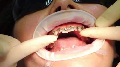 Woman Receiving Dental Treatment with Braces Close Up