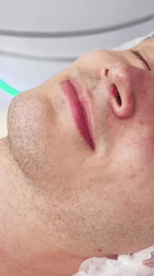 Man Receiving Laser Facial Treatment