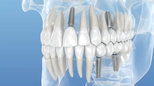 Teeth recovery with dental implant, transparent view. Medically accurate 3D Animation