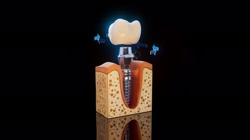 3D Dental Implant Placement Procedure Medical Animation