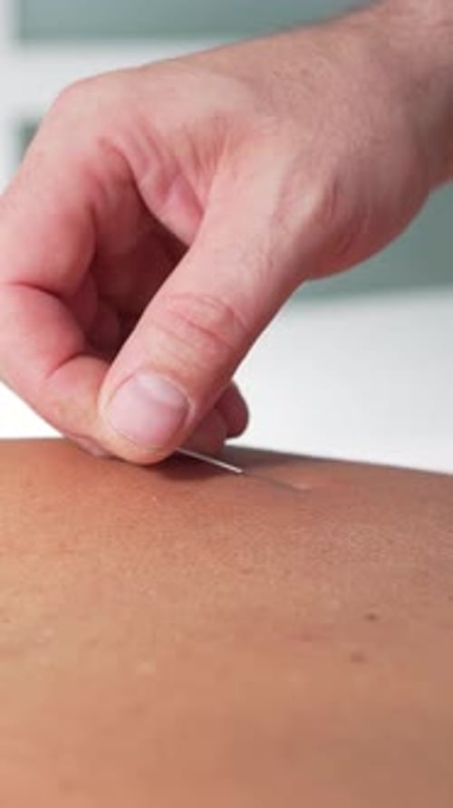 Aguja de tratamiento de acupuntura: inserción manual de la aguja de acupuntura en la espalda para terapia de bienestar