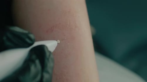 Dermatologist Using Treatment Tool on Arm