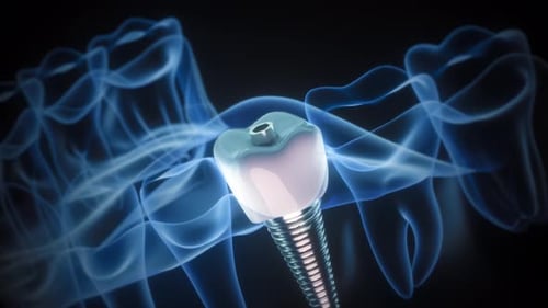 3D Medical Animation of Dental Implant Procedure
