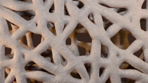 Osteoporose mit Verlust der Knochendichte