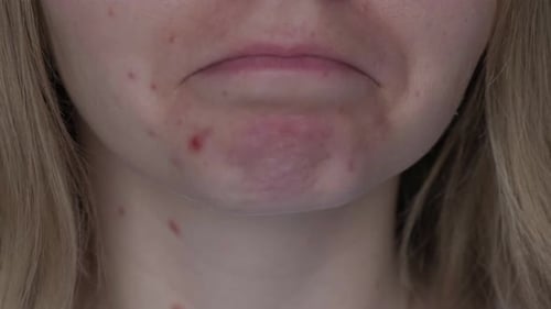 Unrecognizable Woman Upset Showing Her Acne on Face