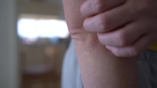 A woman itches a bite in the elbow area, bug bite. Young woman scratching arm from having itching.