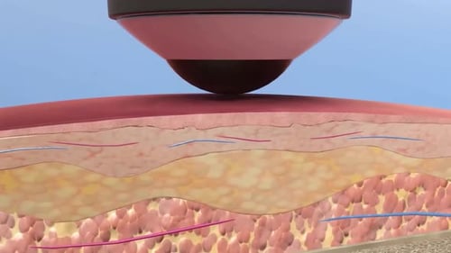 3D Animation of Medical Device Affecting Dermal Tissue