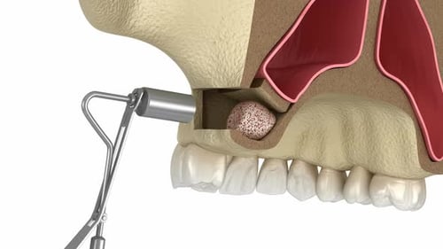 Cirugía de lifting sinusal con acceso lateral. Animación 3D de una cirugía dental