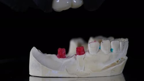 Dental Bridge on Plaster Cast of Teeth