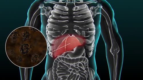 Gallstones, 3D illustration showing bottom view of liver and gallbladder with stones
