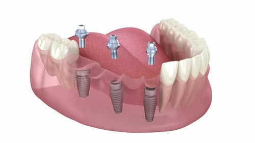 Dental bridge based on 3 implants