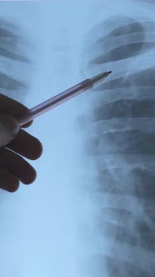 Acromial End Of The Clavicle