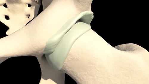 Medical Animation of Human Hip Joint Arthritis