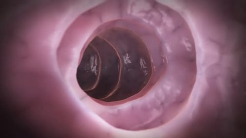 Medical animation showing a polyp growing inside the human colon