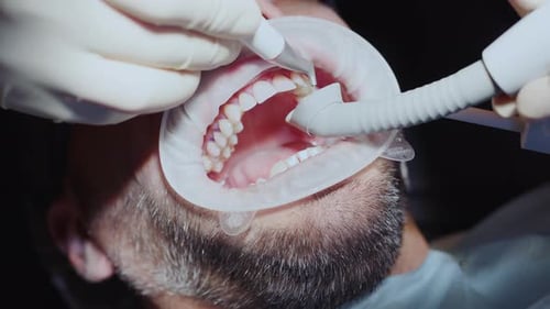 Close Up Hands of Dentist Cleans a Man's Teeth Hydience and Healthy in Modern Clinic Healthcare
