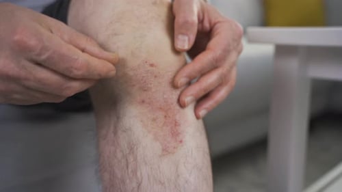 Close-up man scratching a red rash on his leg. Allergies and skin diseases.