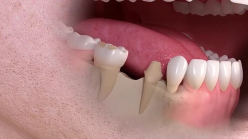 Close-up of human mouth with dental implant