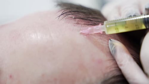 Macro shot of Hair mesotherapy procedure in the modern cosmetology clinic, plasma injectiions.