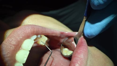 Dental Care Extreme Close Up Macro Video Dentist Treat Patient Teeth Orthodontist Works with