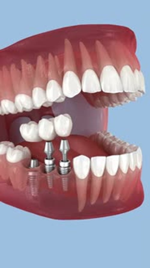3D Animation of Dental Implant Surgical Procedure