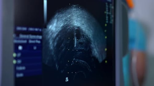 Image ultrasonique sur l'écran à ultrasons. Gros plan Vérification de l'abdomen avant la procédure de FIV.
